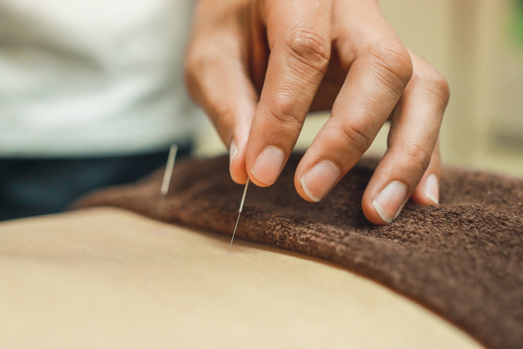 Acupuncture needles for woman's body. Alternative medicine.